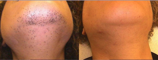 Laser hair on sale removal toronto